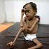 Pothranjeno dijete u Jemenu