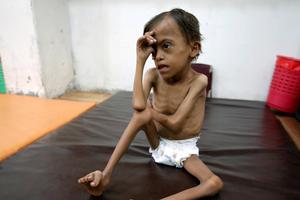 Pothranjeno dijete u Jemenu