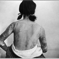 Victims Of Hiroshima Bombing