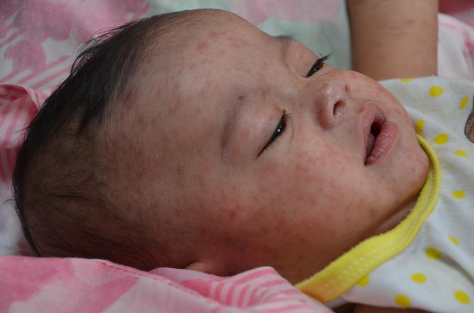 Beba oboljela od ospica | Author: CDC Global/ Flickr/ CC BY 2.0