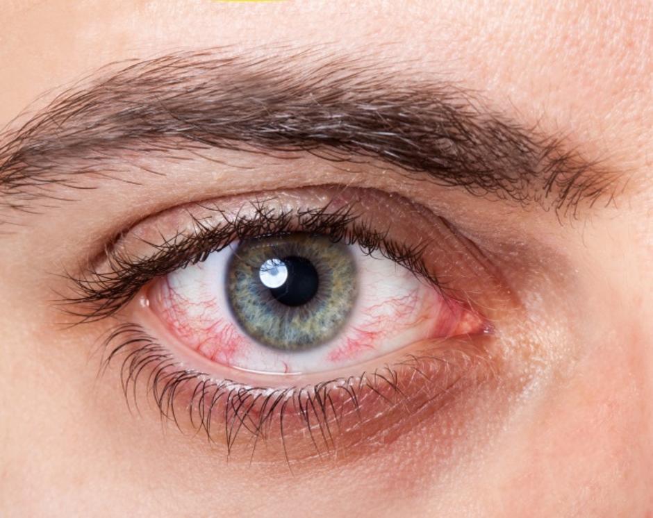 Zdravstveni simptomi vidljivi na očima | Author: brightside.me