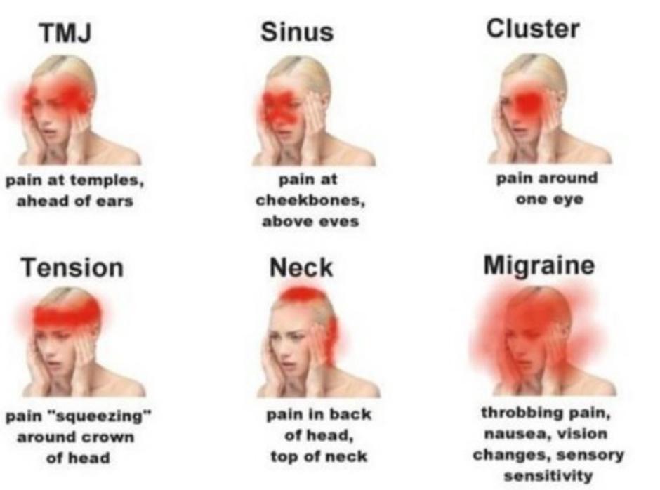 Tipovi glavobolje s obzirom na mjesto boli | Author: Facebook