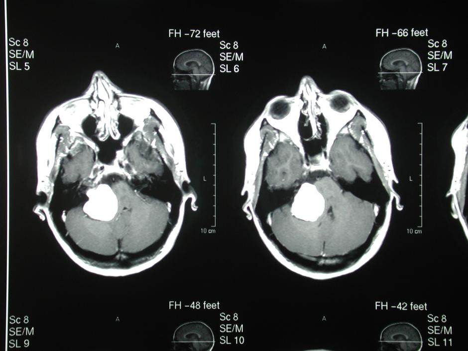 Tumor u mozgu | Author: Eric Lewis/ Flickr/ CC SA 2.0