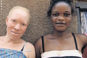 Albino iz Ugande
