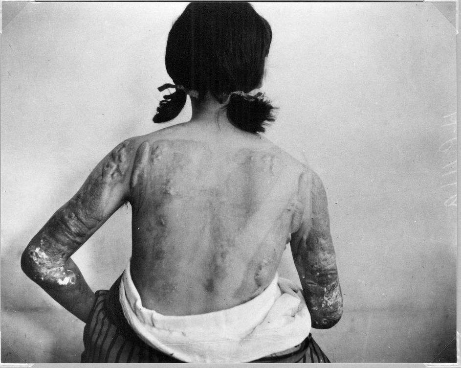 Victims Of Hiroshima Bombing