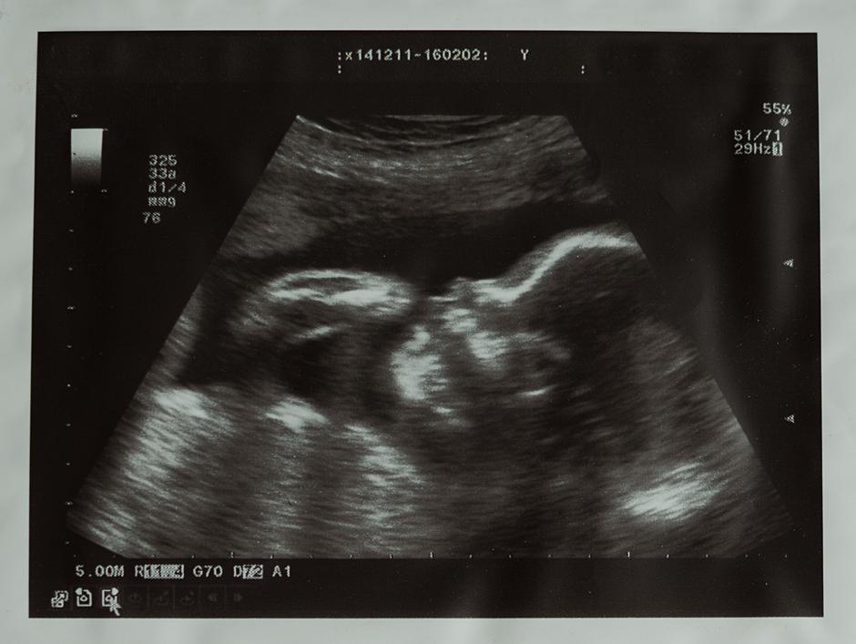 Ultrazvučna snimka bebe u maternici | Author: Thinkstock