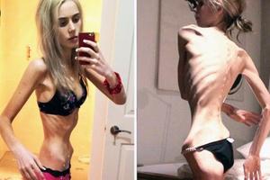 Najšokantniji slučajevi anoreksije