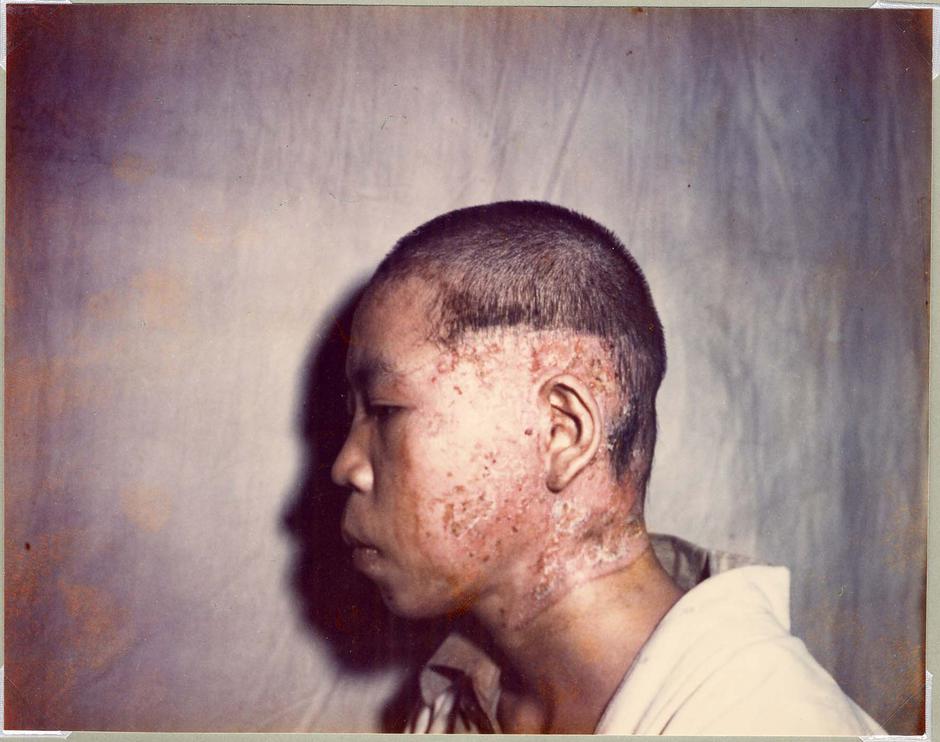 Victims Of Hiroshima Bombing | Author: Profimedia