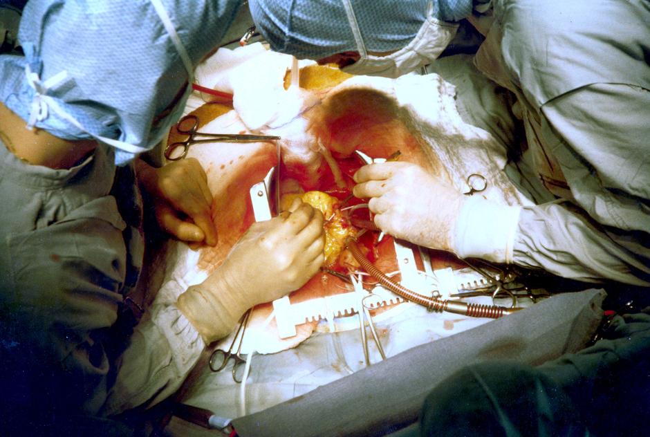Operacija srca iz 1981. | Author: public domain