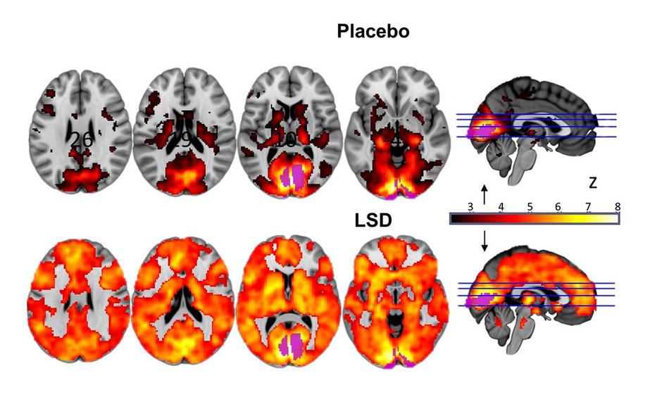 Mozak pod utjecajem LSD-a | Author: Imperial/Beckley Foundation 