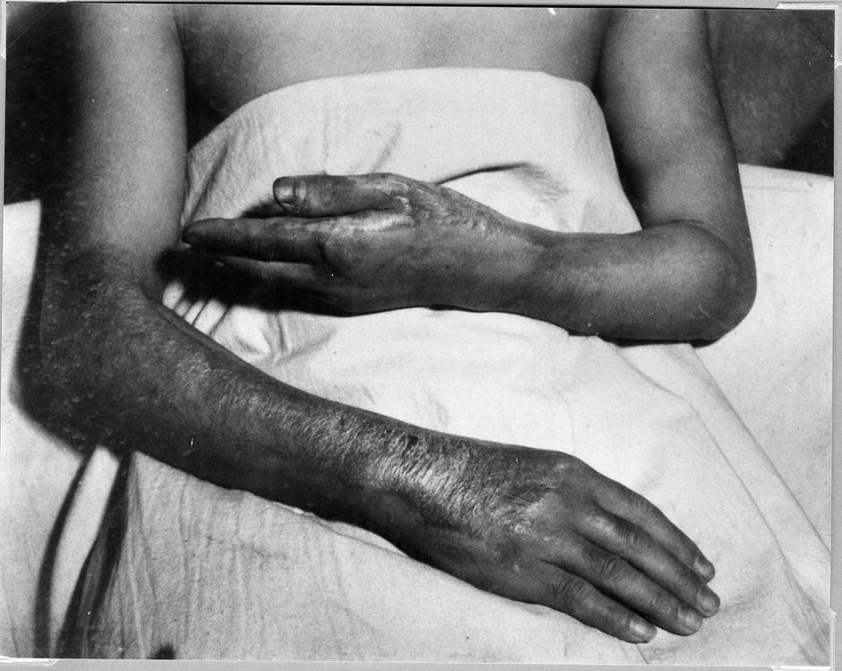 Victims Of Hiroshima Bombing | Author: Profimedia