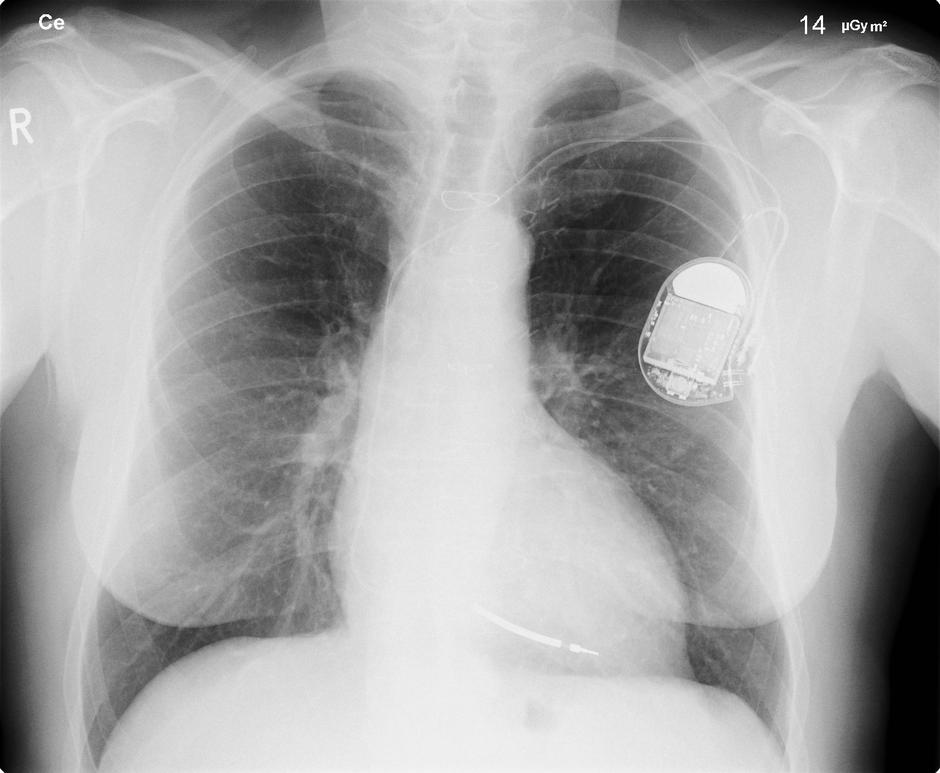 Rentgen pacijenta s pacemakerom | Author: Wikipedia
