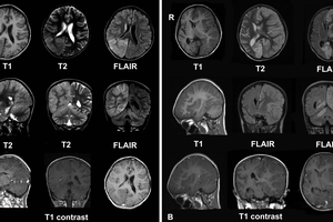 CT snimka mozda djeteta oboljelog od Rasmussenovog encefalitisa