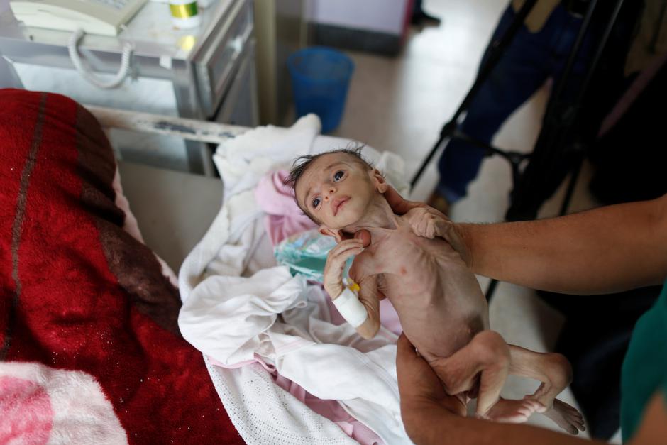 Djeca u Jemenu umiru od gladi | Author: Khaled Abdullah/REUTERS/PIXSELL