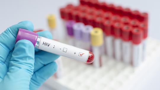 Uzorci krvi zaraženih AIDS-om