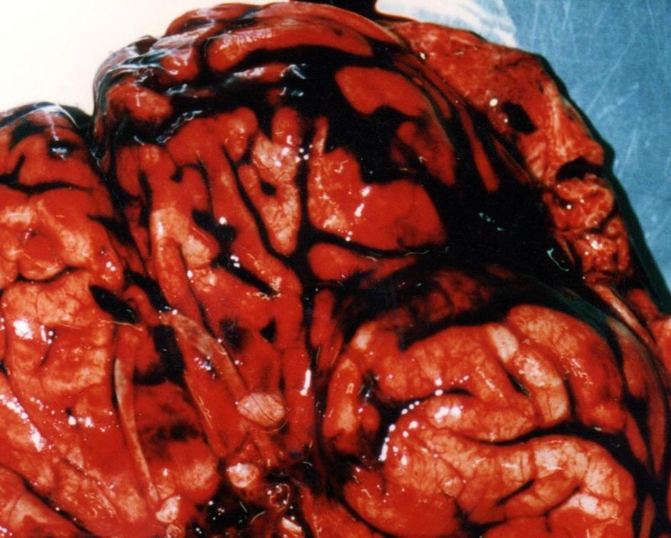 Mozak osobe preminule od moždanog udara | Author: Amadalvarez/ CC BY-SA 4.0