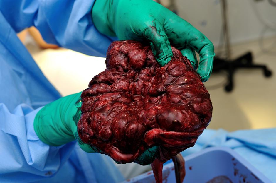 Organ posteljice nakon porođaja | Author: Thinkstock
