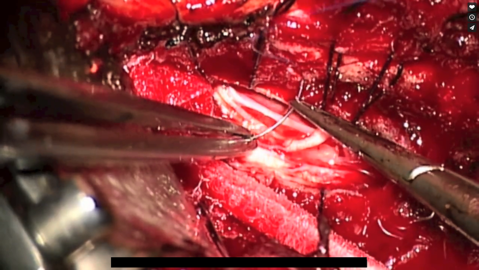 Operacija tumora u kralježnici | Author: Vimeo