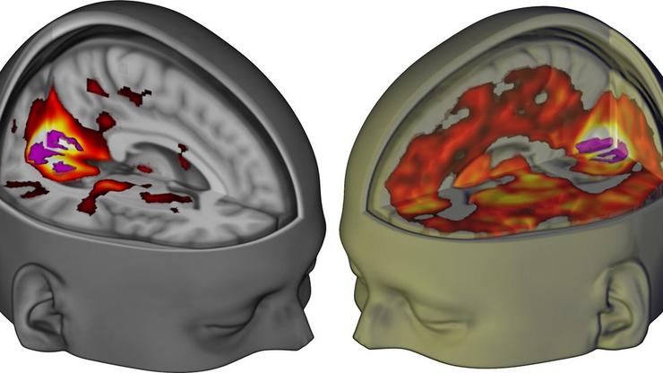 Mozak pod utjecajem LSD-a
