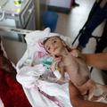 Djeca u Jemenu umiru od gladi