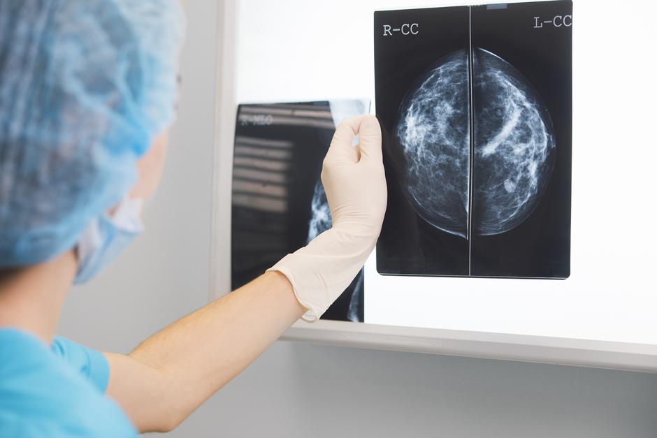 Mamografski nalaz | Author: Thinkstock