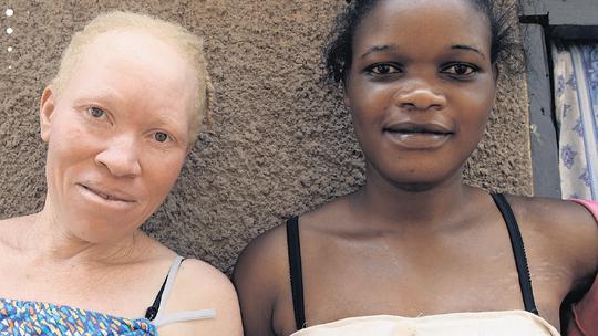 Albino iz Ugande
