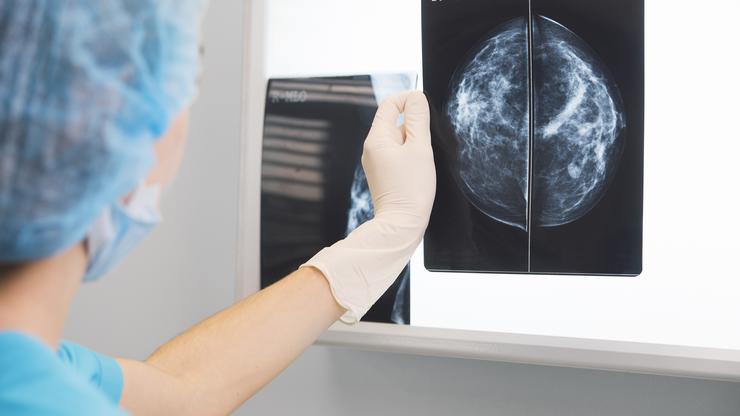 Mamografski nalaz