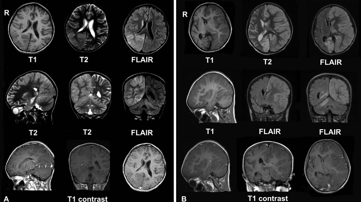 CT snimka mozda djeteta oboljelog od Rasmussenovog encefalitisa