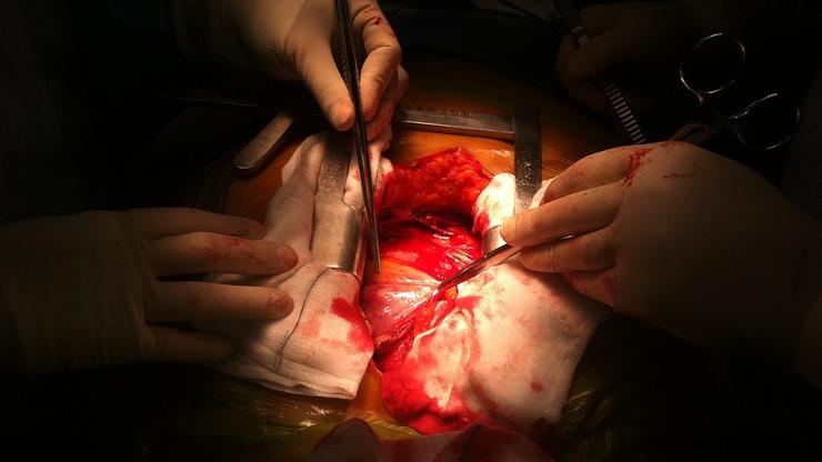 Operacija srca