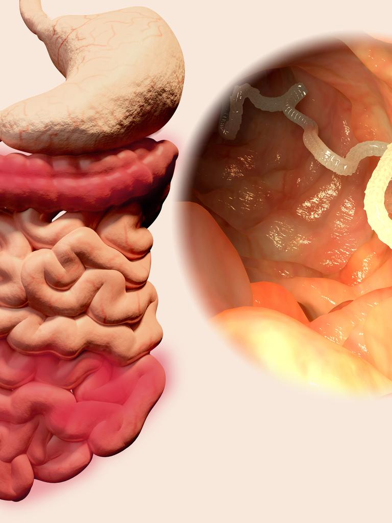 kako prepoznati parazite u tijelu după îndepărtarea recuperării verucilor genitale