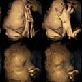 Snimka ultrazvuka fetusa pušačice