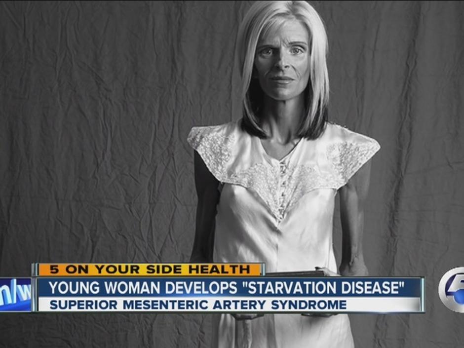 Manekenka umrla od misterioznog poremećaja prehrane | Author: screenshot/youtube