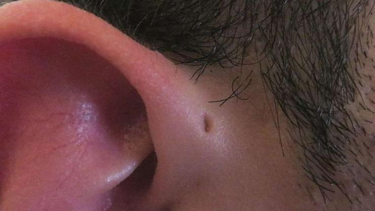 Prikaz rupice na uhu