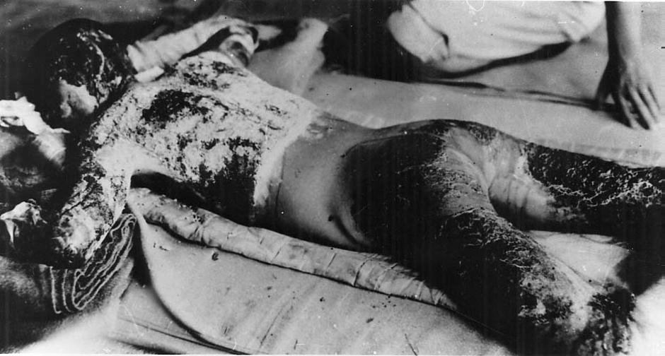 Victims Of Hiroshima Bombing | Author: Profimedia