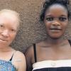 Albino iz Ugande