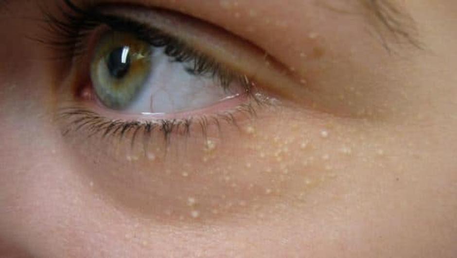 Zdravstveni simptomi na očima | Author: Pinterest