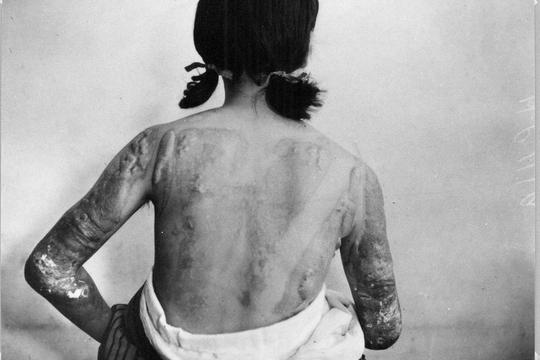 Victims Of Hiroshima Bombing