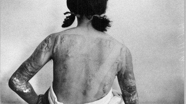 Victims Of Hiroshima Bombing